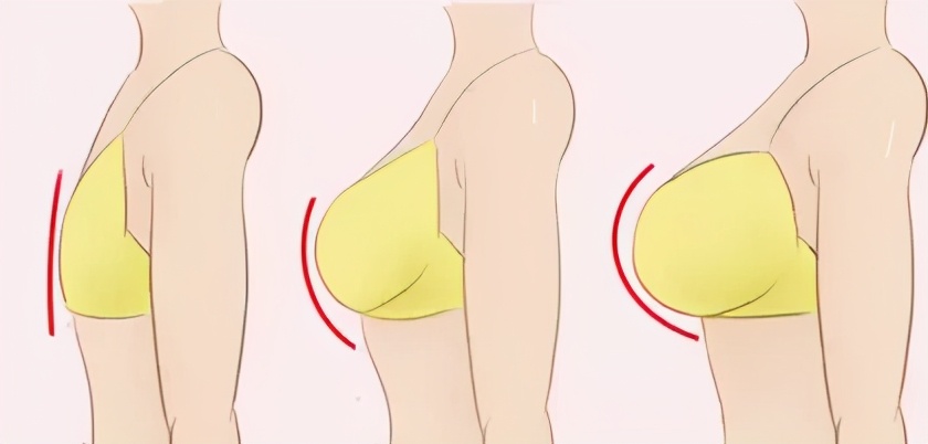 自体脂肪和假体隆胸的优缺点,假体隆胸与自体脂肪的区别