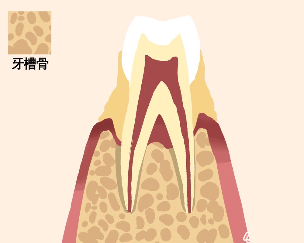 牙周疾病引起牙齿松动,牙周问题导致牙齿松动怎么办