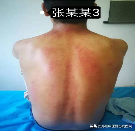 李氏砭法刮痧直播,李氏虎符铜砭刮痧治腰椎间盘突出
