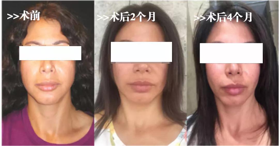 医美最火的项目,哪些皮肤类医美项目不建议做