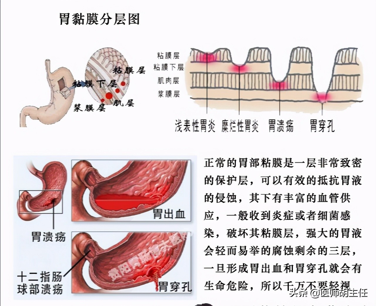 阿司匹林肠溶片对胃粘膜有损伤吗,小剂量阿司匹林对胃粘膜损伤大吗