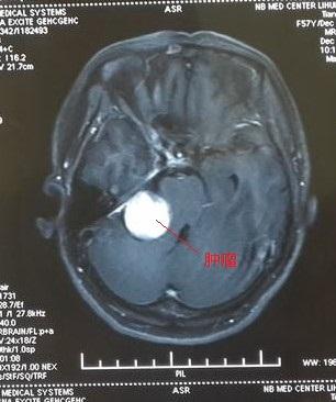 眼皮老是跳怎么回事？神经科医生：这个病要警惕了