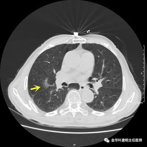 多发原发肺癌能根治吗,肺部原发性恶性肿瘤好治