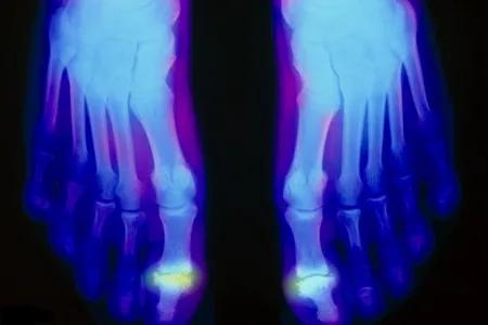 手指风湿性关节炎症状和治疗方法,风湿性关节炎症状和治疗方法成都