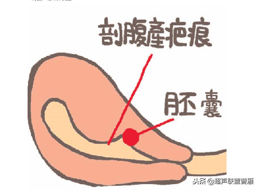 剖宫产疤痕妊娠几率,剖宫产疤痕妊娠及其护理