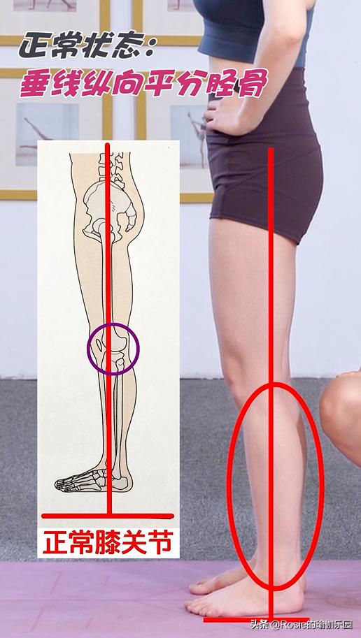 锻炼小腿内侧肌肉改善O型腿,小腿粗大腿壮如何变细腿