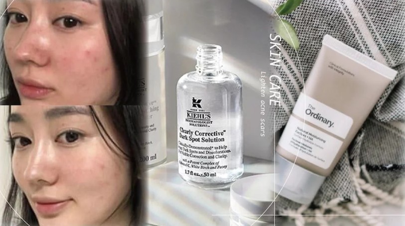 效果超好的祛痘印精华平价,好用的淡化痘印产品