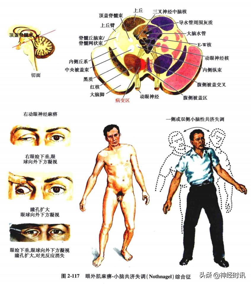 脑干解剖,脑干神经解剖