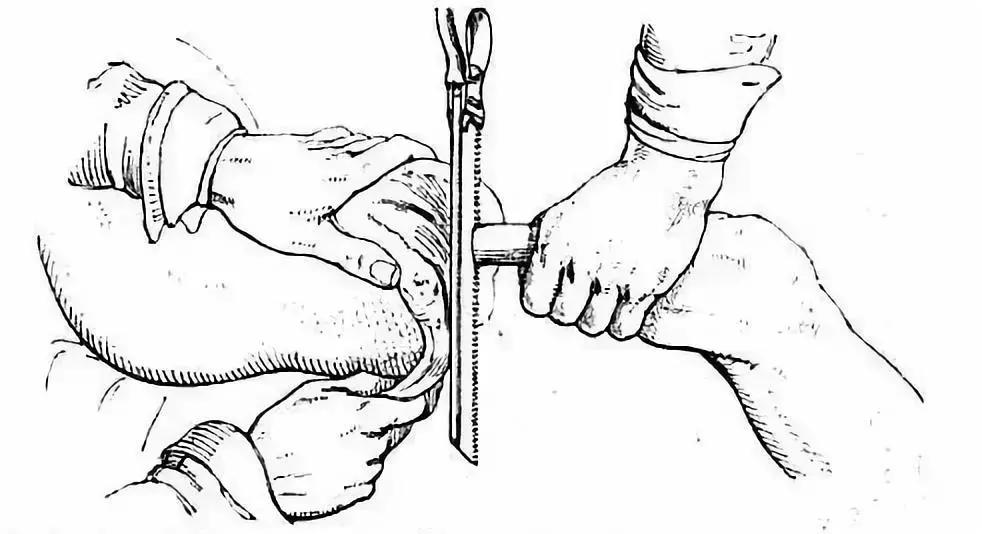 没有麻醉会疼死吗,无麻醉手术有多可怕