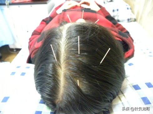 华佗治曹操的病为什么要开颅,华佗有没有技术给曹操做开颅手术