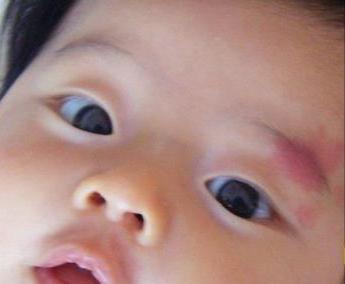 血管瘤到底要不要处理,血管瘤好不好治