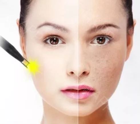 脸上的黑色素怎么改善,脸上有黑色素用什么办法慢慢淡化