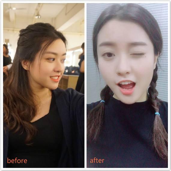 光了嫩肤后皮肤会变光滑吗,皮肤黑光子嫩肤10天变化图片