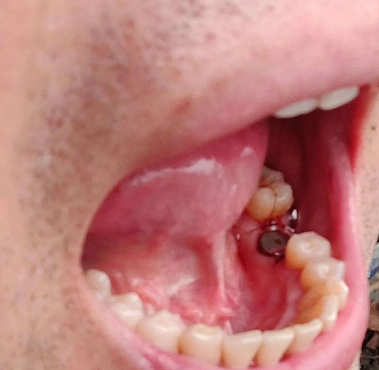 成都华西口腔医院全口种植牙,2023华西口腔医院种植牙价格