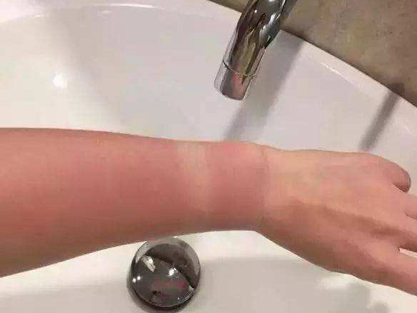 夏天湿疹与夏季皮炎的区别,顽固湿疹日光性皮炎怎么治