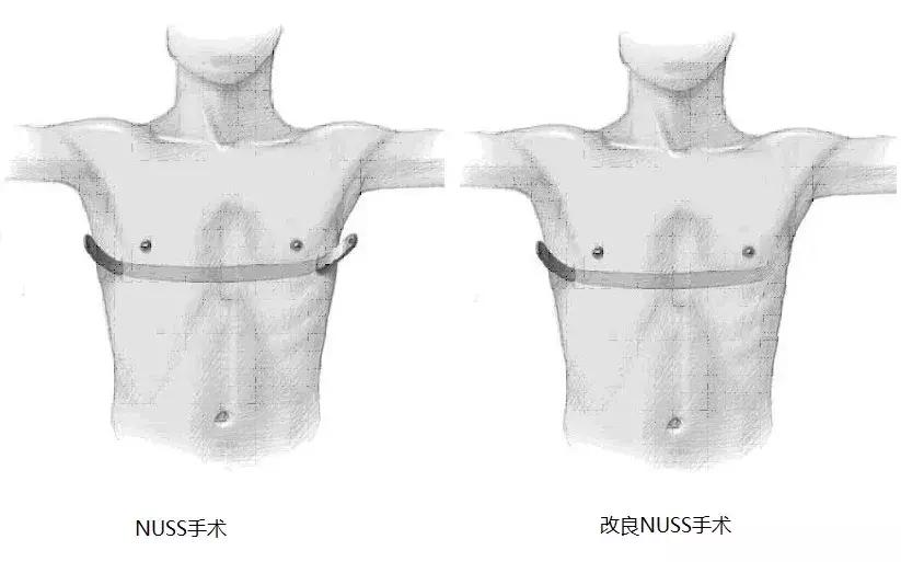 「拿掉」胸上的「漏斗」，让这个孩子挺起胸膛
