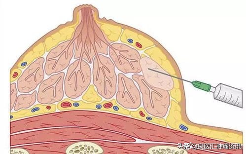 穿刺检查后疼痛、出血正常吗？哪些情况该再去医院跑一趟？
