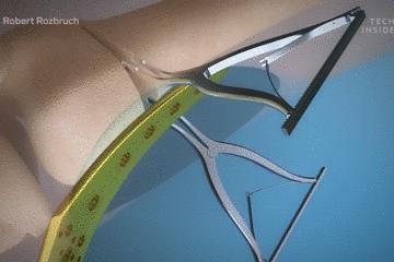 手术的时候医生对你做了什么,手术时切了一片肺叶