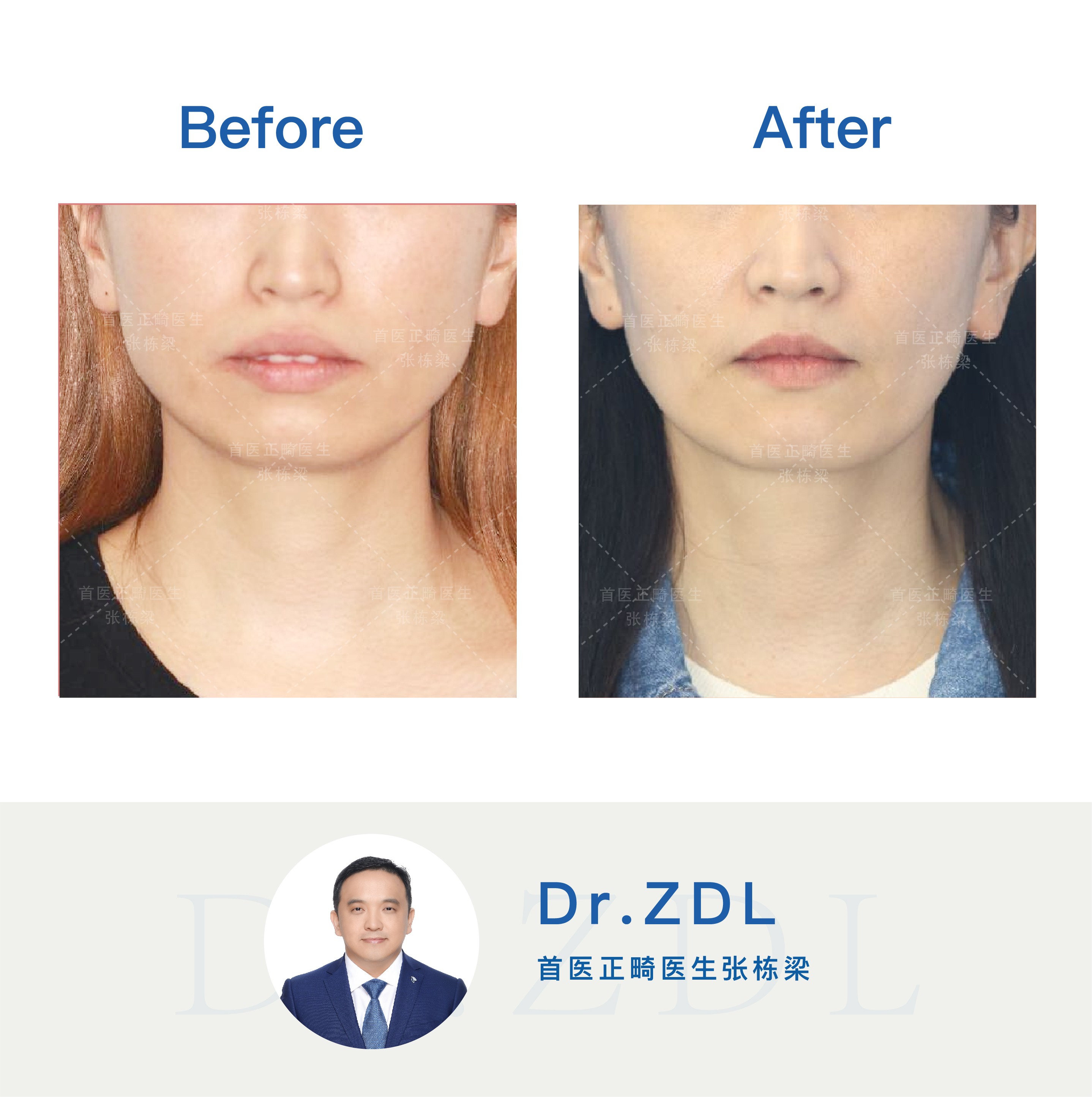 嘴突不做牙齿矫正后果,嘴突没有龅牙可以修复吗