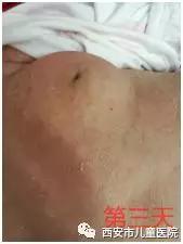 挤压新生宝宝的乳腺？挤出的只能是痛苦和后悔！