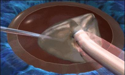 眼科医生郭海科治疗白内障,郭海科白内障