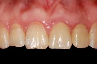 我才20岁为什么牙齿会碎掉,27岁缺牙不补有什么坏处