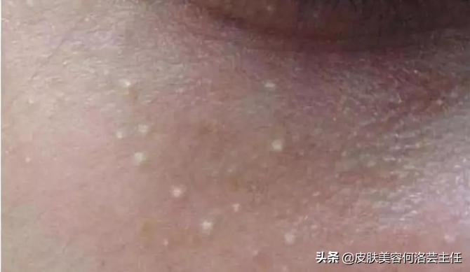 脂肪粒是怎么形成的怎样根除,脂肪粒是怎么形成的怎么处理