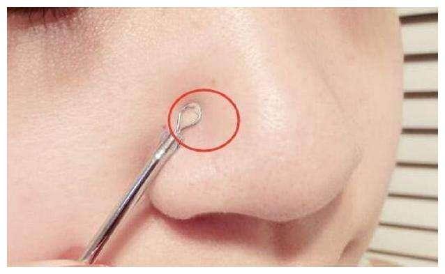 牙膏真的可以去黑头吗,黑头清理方法学生不花钱用牙膏