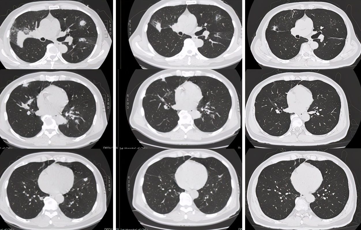 肺部肿块抗炎治疗无变化怎么办,病灶呈轻中度持续强化