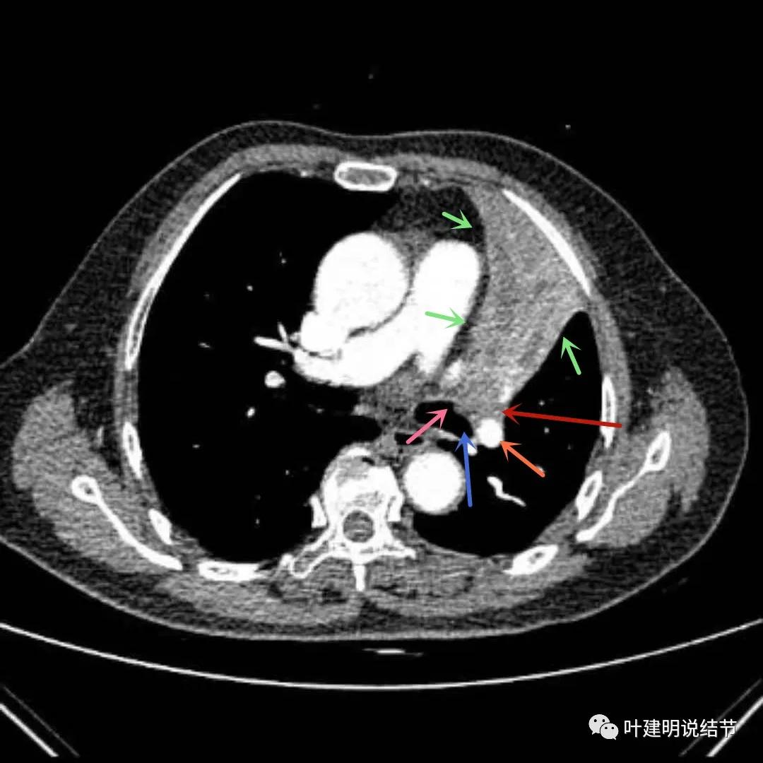 高龄肺癌靶向治疗效果,高龄老人肺癌早期适合放疗吗