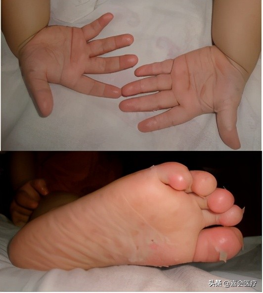 手足口病你必须知道,手足口病最新版知识解读