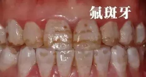 牙齿脱矿有必要治疗吗,牙齿脱矿龋齿可以不做牙贴面吗