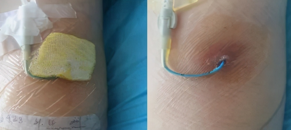 碘伏治疗PICC导管穿刺点感染的体会