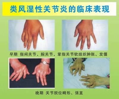 手指关节晨僵怎么治有好办法吗,手指关节晨僵的解决办法