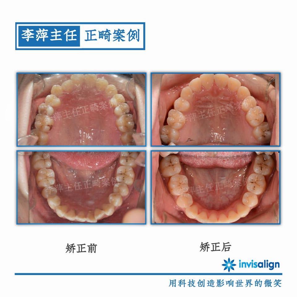 深覆合牙齿不齐矫正案例,29岁牙齿矫正龅牙前突案例