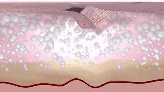 大眼袋眼纹抹平了,眼纹医美怎么去除