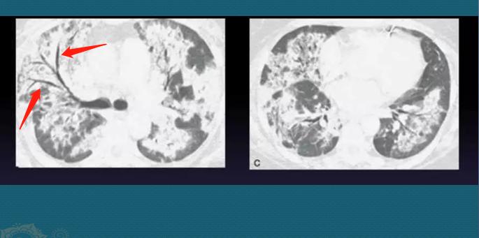 17岁肾炎，30岁尿毒症咳血，医生说有些病要尽早去大医院，能救命