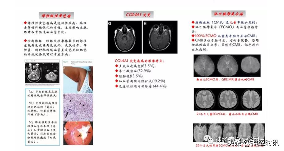 缺血性脑血管病出血评估,脑血管微出血怎么治疗