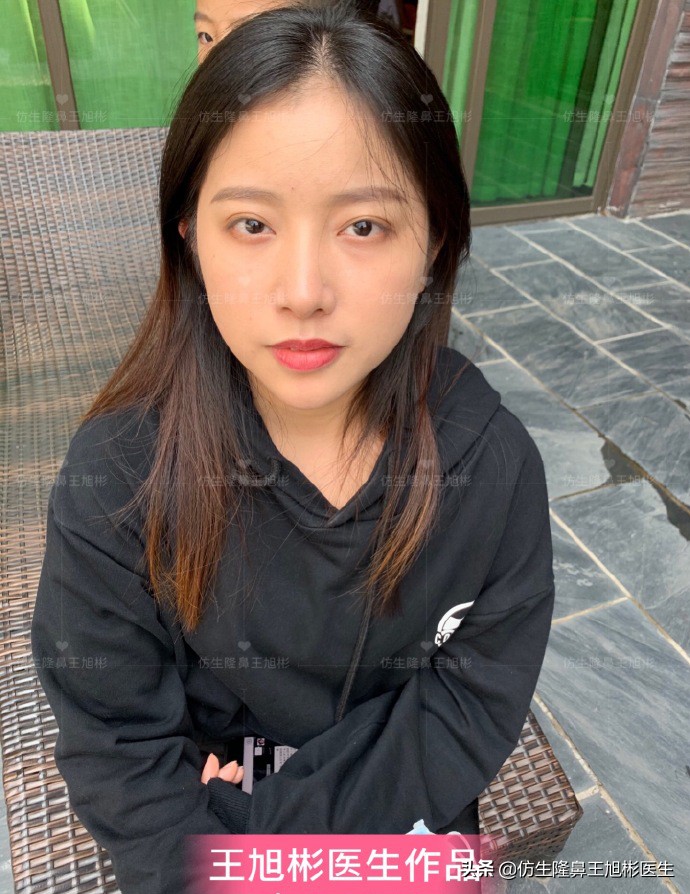 手术鼻头增厚能用什么方法弄,大鼻头高鼻梁缩小手术案例