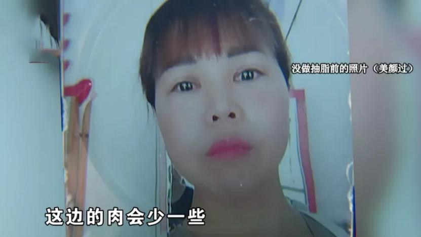 做完抽脂脸上有凹陷,脸颊两边抽脂后有鼓包怎么回事