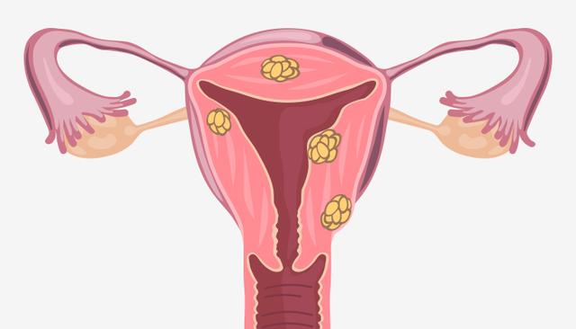宫腔粘连你是否还在走弯路（上）