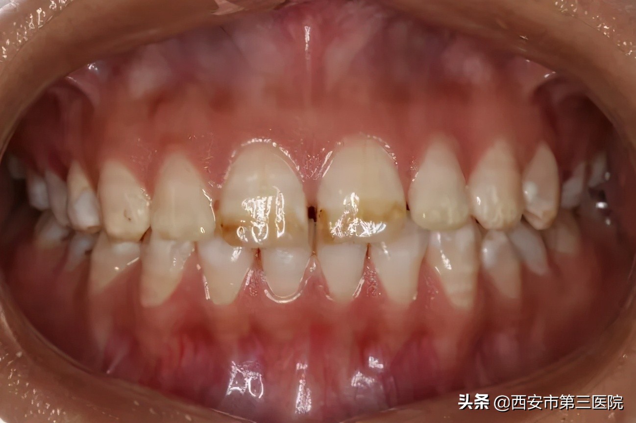 常见牙齿美白方式大盘点,牙齿美白性价比最高的方法