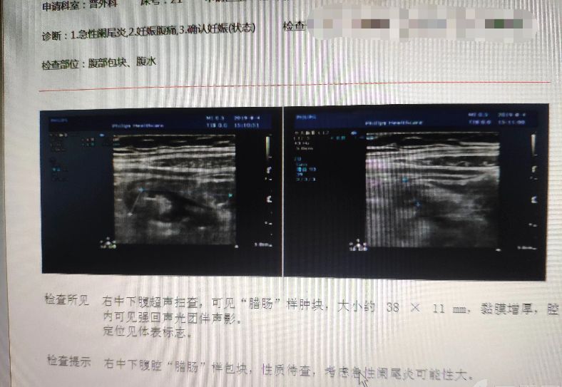孕早期44天急性化脓阑尾炎该咋办,阑尾炎保守治疗中腹痛