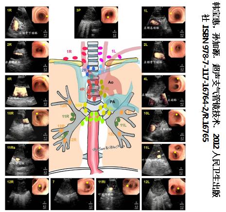 全球对肺癌治疗的最有效最新技术,肺癌的支气管镜介入治疗