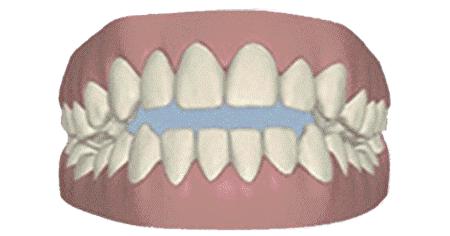 正畸日记补牙,正畸刚戴上牙套的不适应有哪些