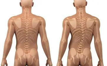 脊柱侧弯专科门诊,脊柱侧弯挂脊柱外科