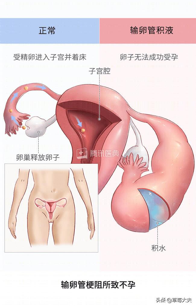 医生也成“催生婆”?不!是你输卵管出问题了......