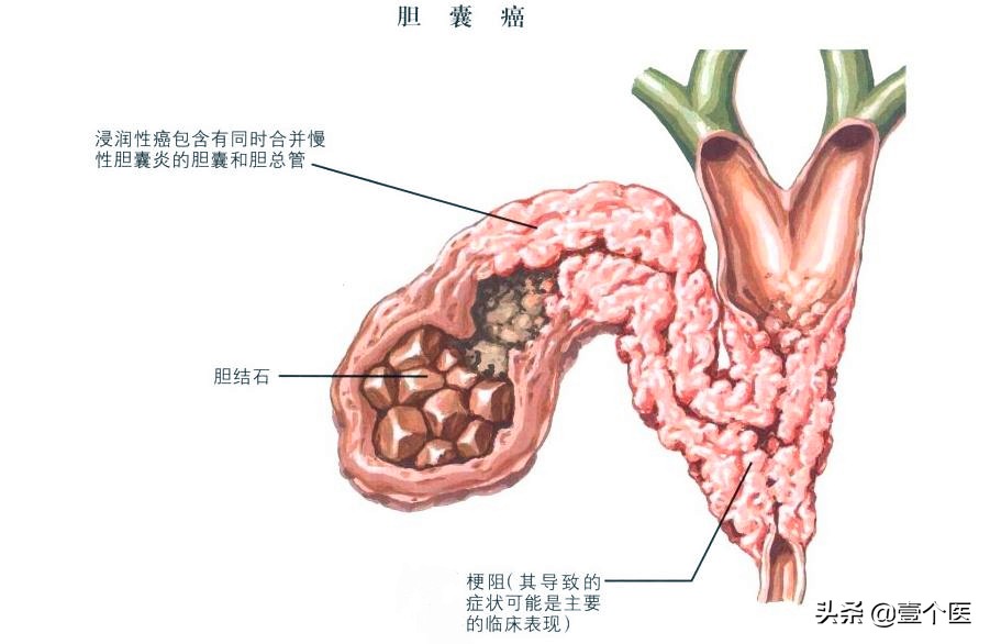 肝胆相照科普,胆囊肝胆相照