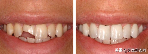 牙齿有断裂迹象该怎么修复,牙齿横向断裂修复最佳方法门牙