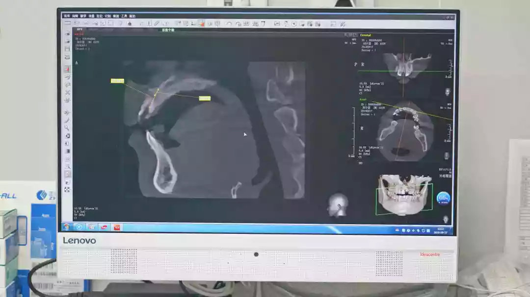 门牙缺失影响父母健康,门牙缺失修补好了影响财运吗